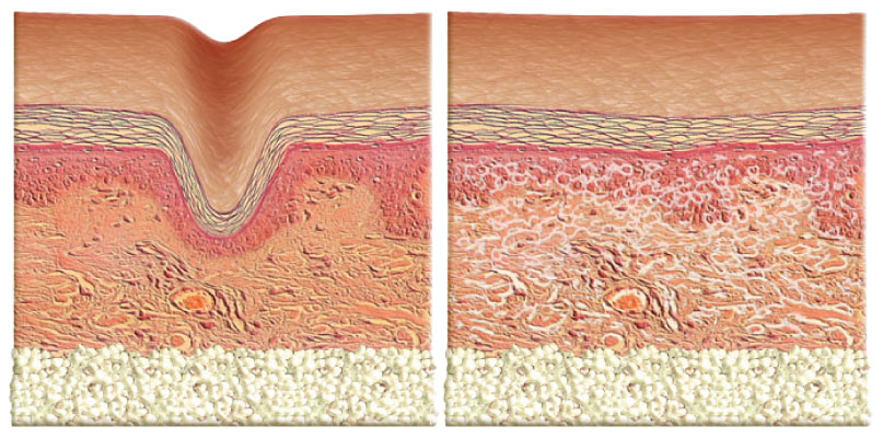 Sketch of how Belotero works to fill in fine lines and wrinkles