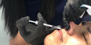 Lip Filler FAQS