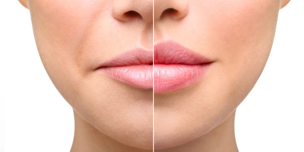 What Are Lip Fillers?