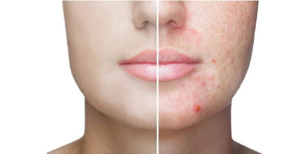 How To Get Rid Of Acne Scars Using A Facial