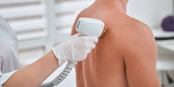 Man receiving laser back hair removal treatment