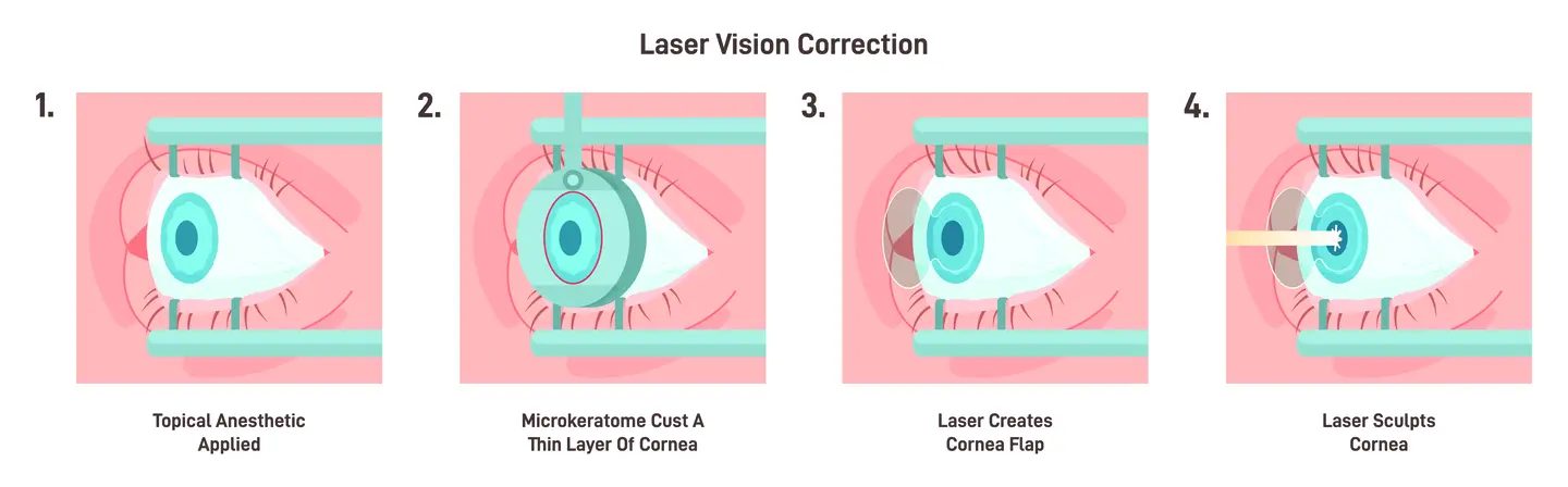 LASIK For Astigmatism In Chicago IL Kraff Eye Institute LASIK For Astigmatism In Chicago IL Kraff Eye Institute
