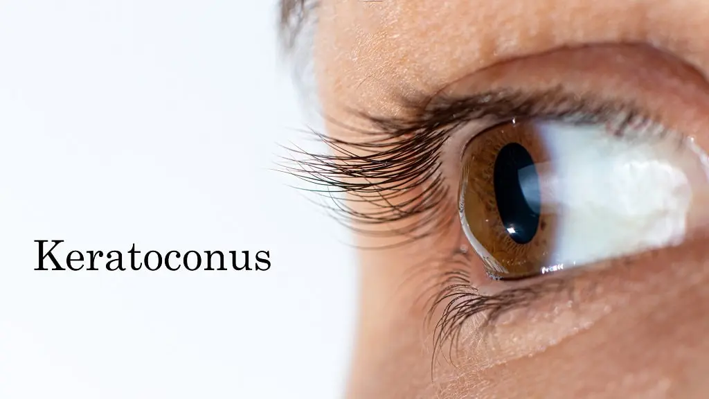 Understanding Keratoconus