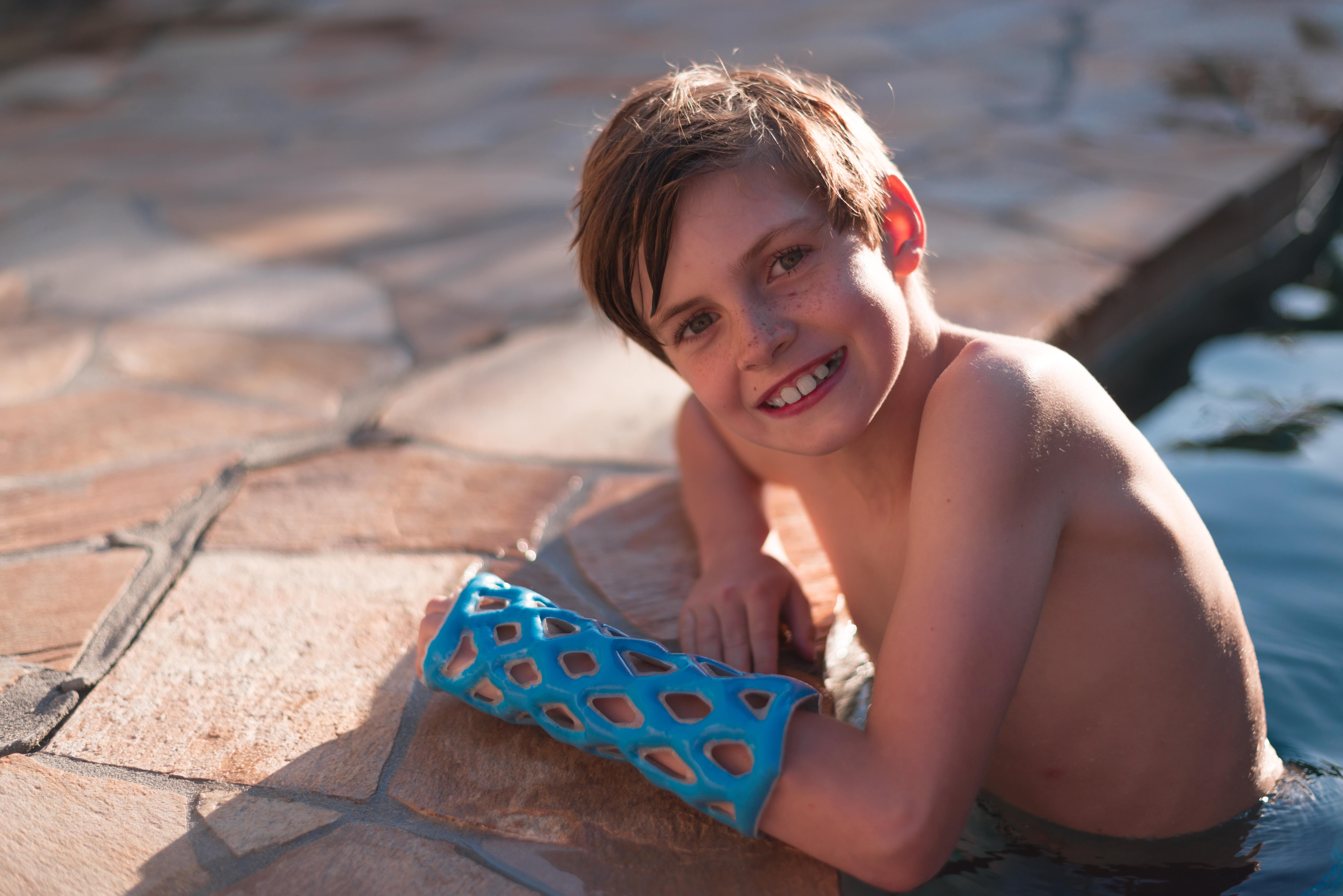 Everything You Need to Know About Arm Casts