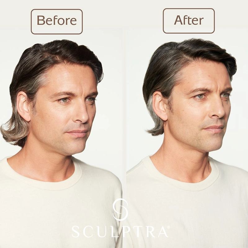 Sculptra® near me Natural Body Spa & SkinReMEDI Atlanta