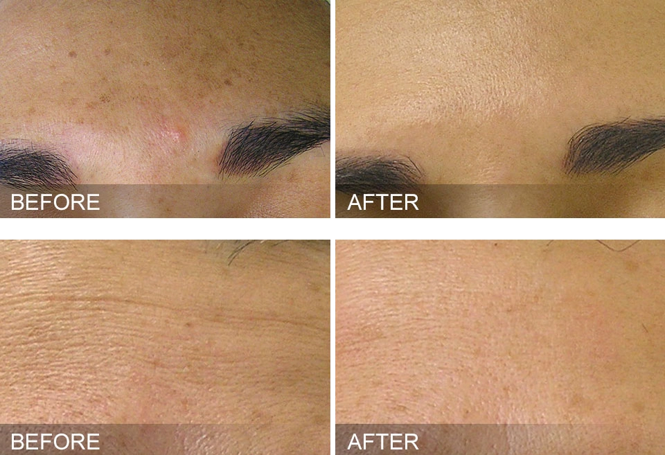 Hydrafacials Natural Body Spa & SkinReMEDI Atlanta & Chattanooga