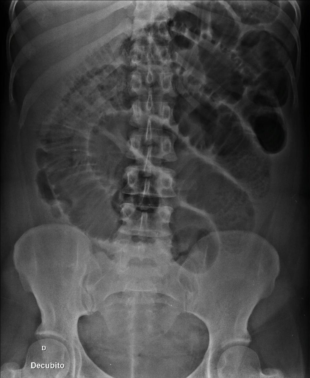 Medicina de Emergência: Abdome agudo obstrutivo: o que é, causas e ...