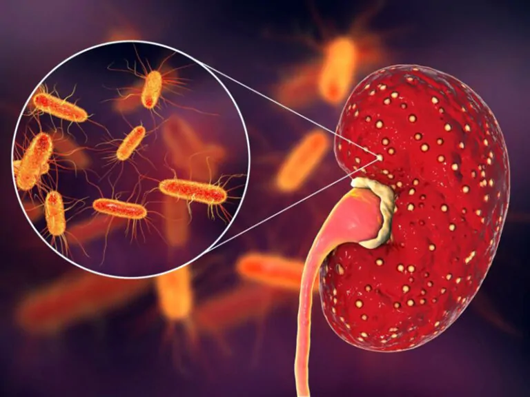 Nefrologia: Infecção do trato urinário: tipos, diagnóstico e tratamento