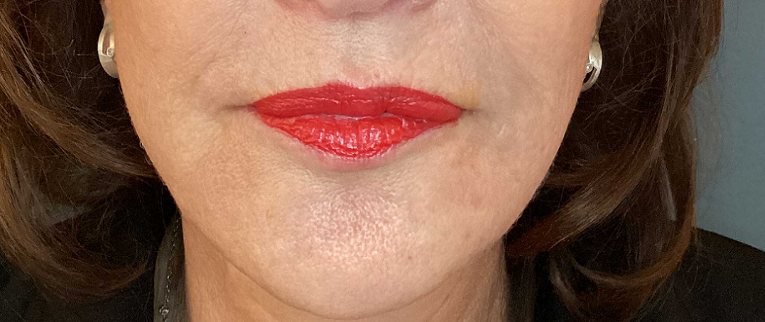 Botuline Toxine en Fillers bij Beauty Centre Maastricht