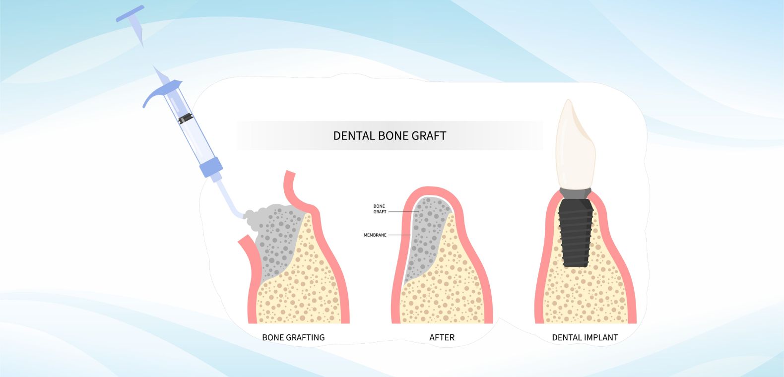 A dental bone graft adds volume and density to your jaw in areas where