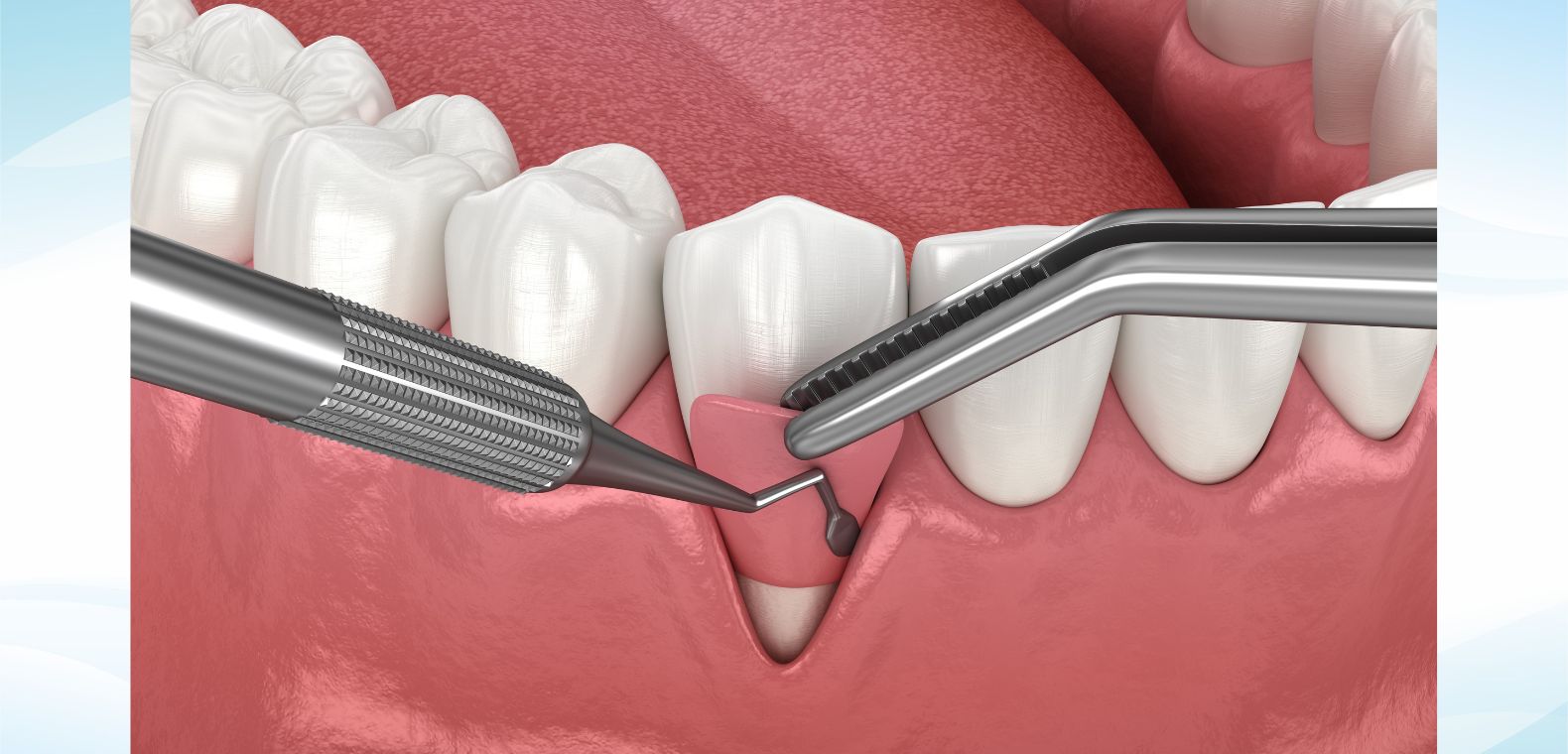 Gum graft surgery is a dental procedure for treating thinning gums or