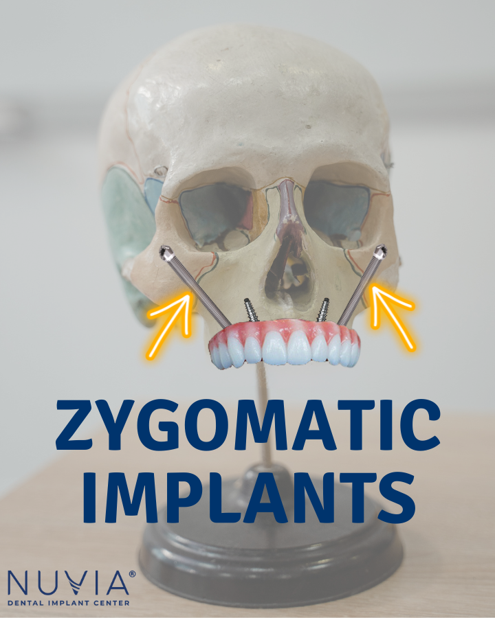 15 Things about Zygomatic Dental Implants You Should Know.