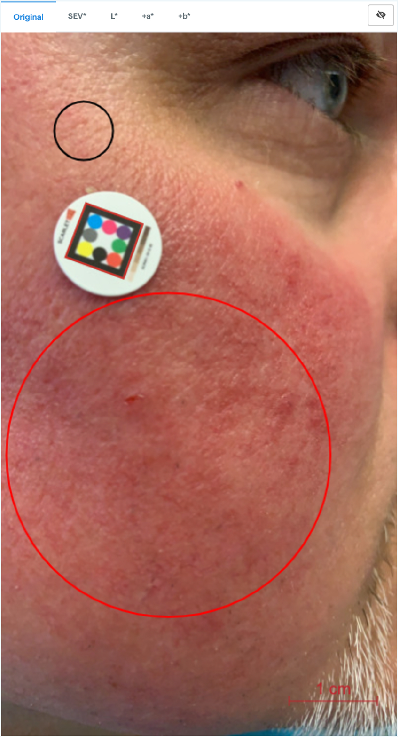 Image assessent with ScarletredVision on a rosaea patient before treatment