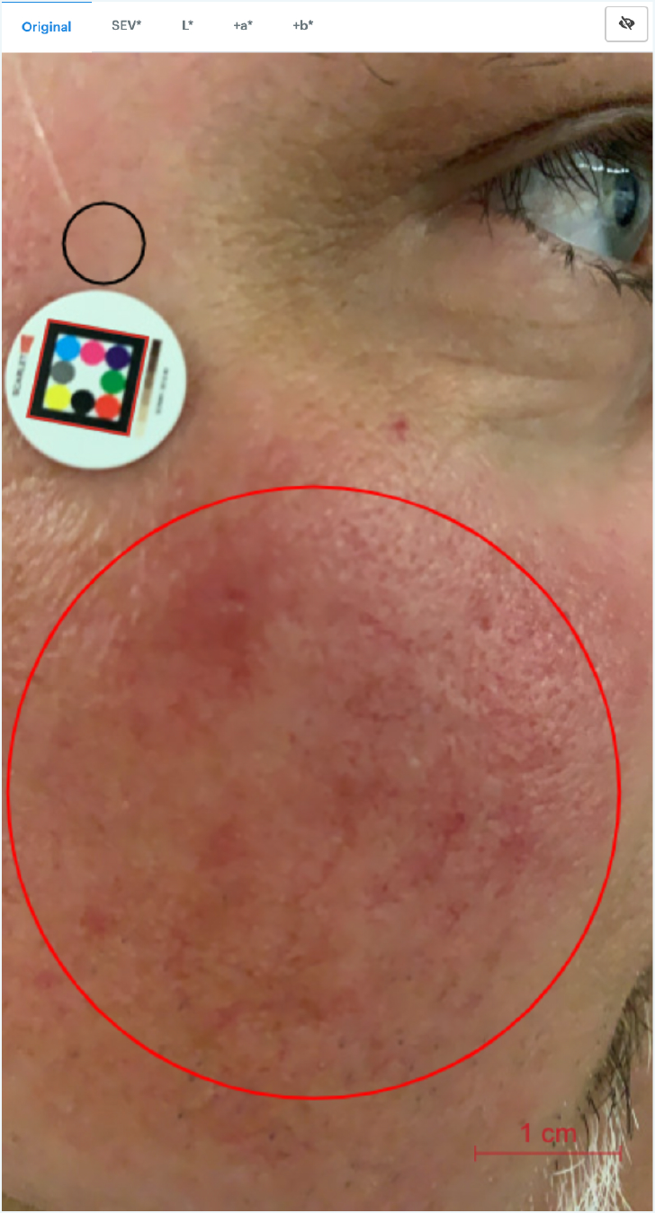 Image assessent with ScarletredVision on a rosaea patient after treatment
