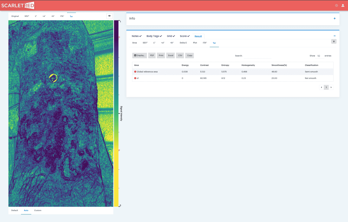 Skin texture analysis result on the ScarletredVision online platform for an epidermolysis bullosa patient