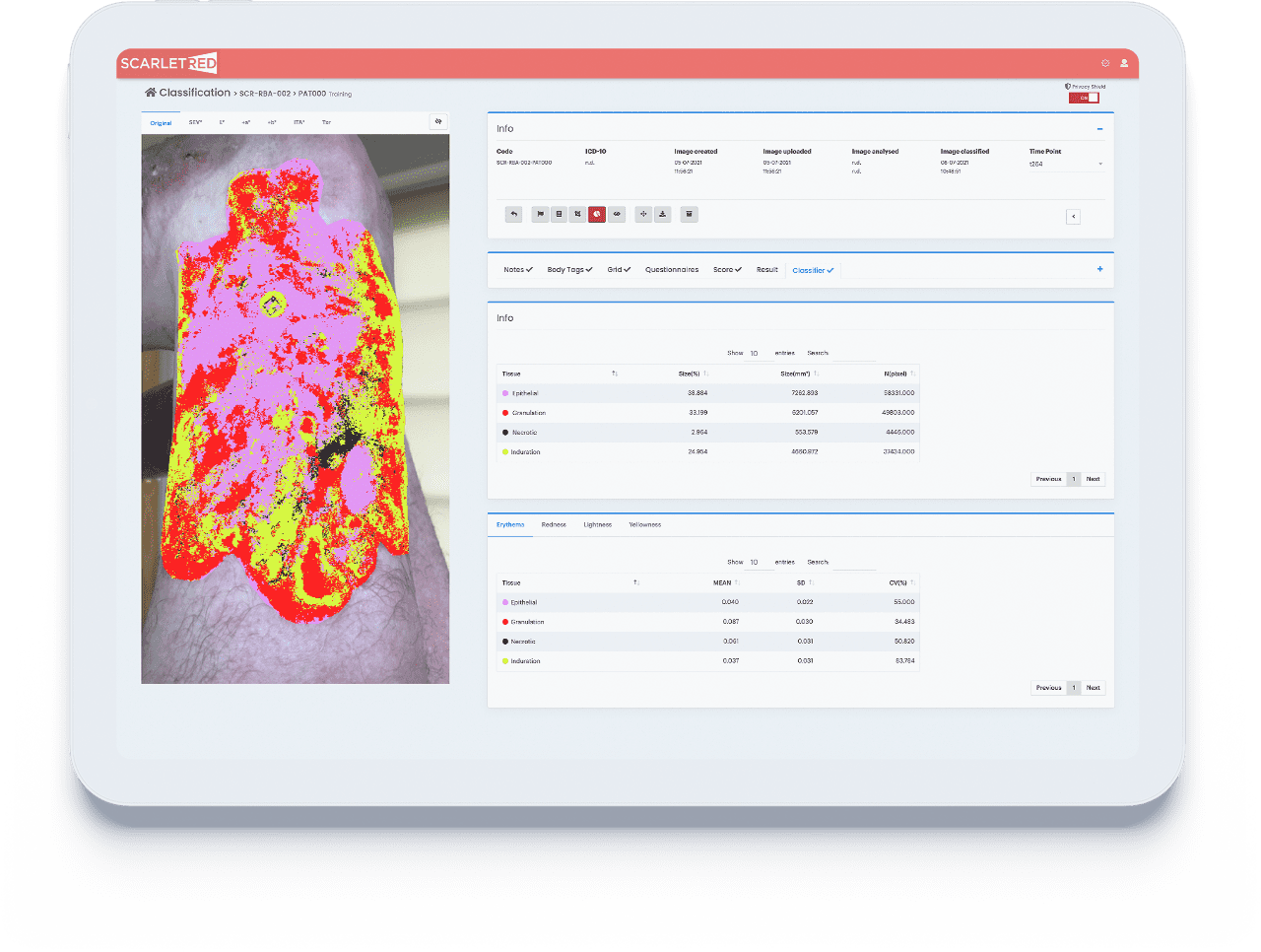 Tissue lassification results shown on the Scarletred Vision platform for an epidermolysis bullosa patient