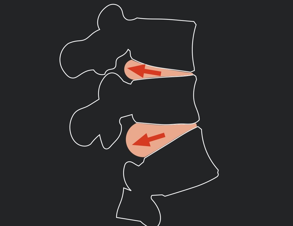Flexed disc spine