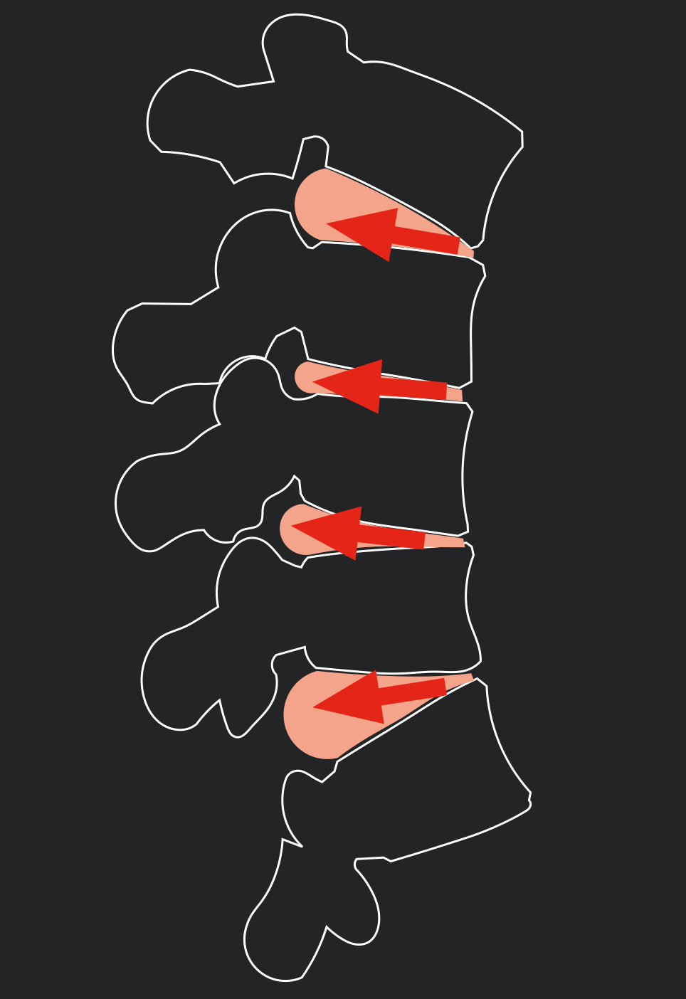 Spinal flexion opens and stretches the rear of the spinal disc.