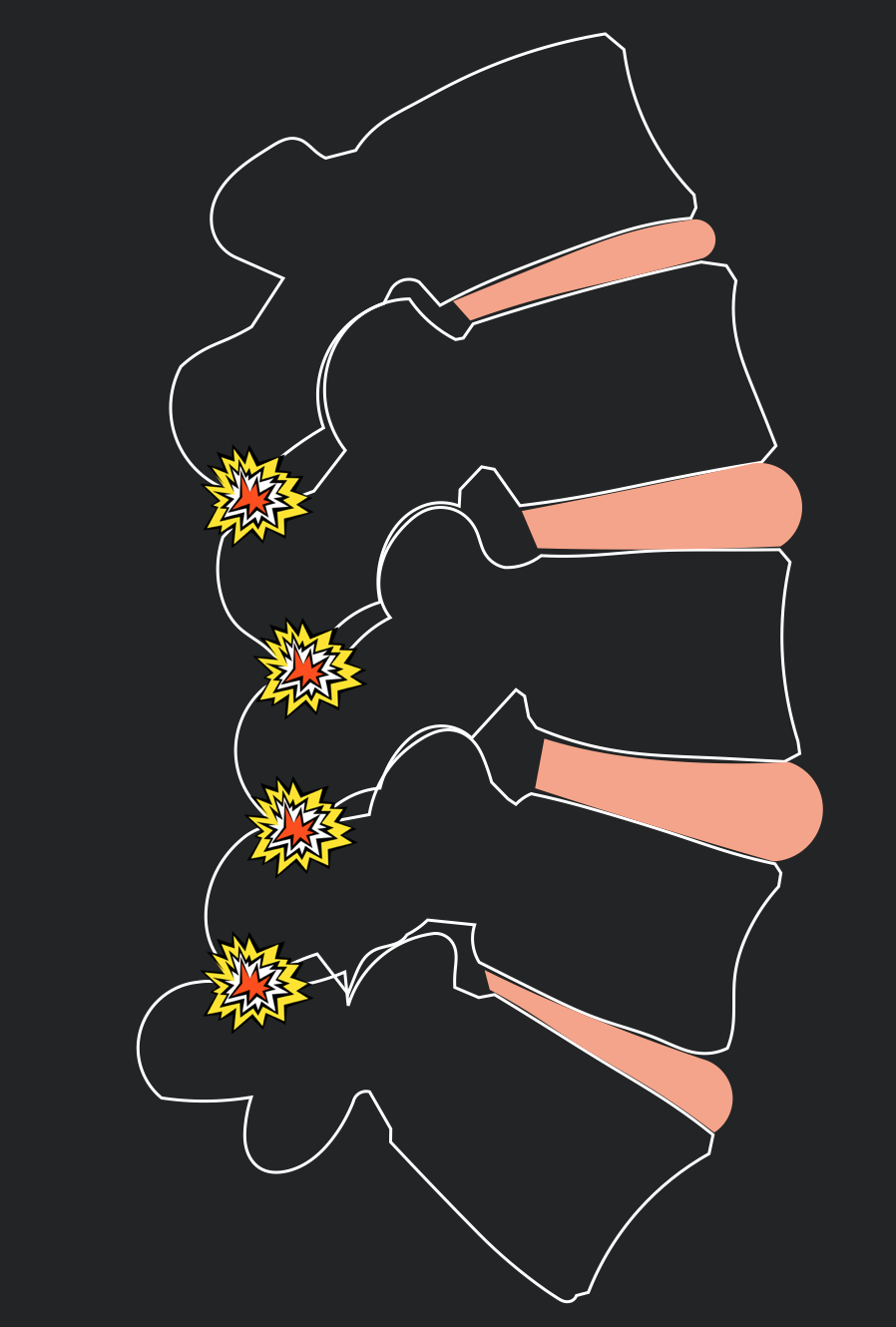 Extension of the spine taken too far can overload the facet joints and spinous process.