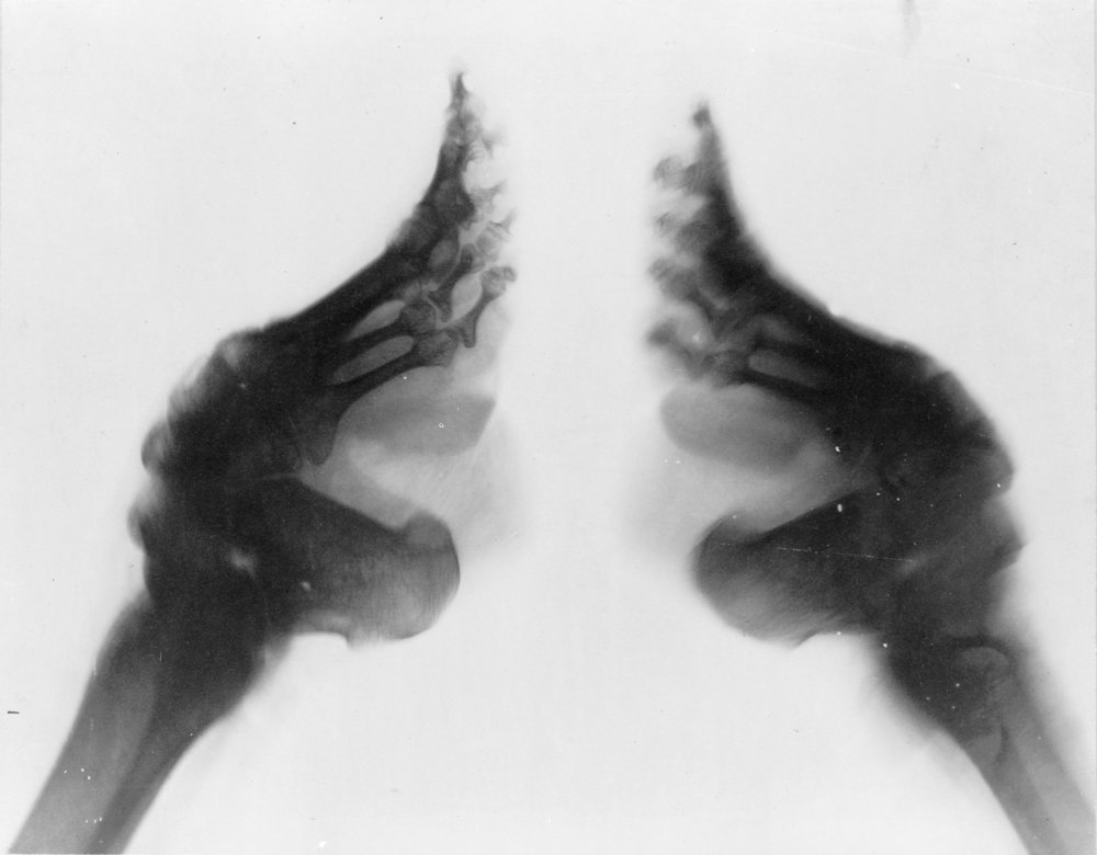 Bound_feet_(X-ray).jpg