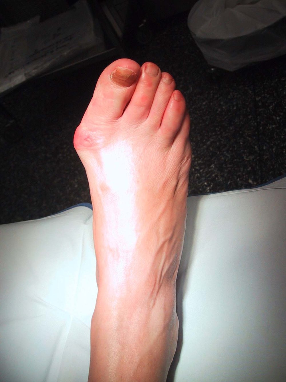 Hallux_Valgus-Aspect_pré_op_décharge.JPG