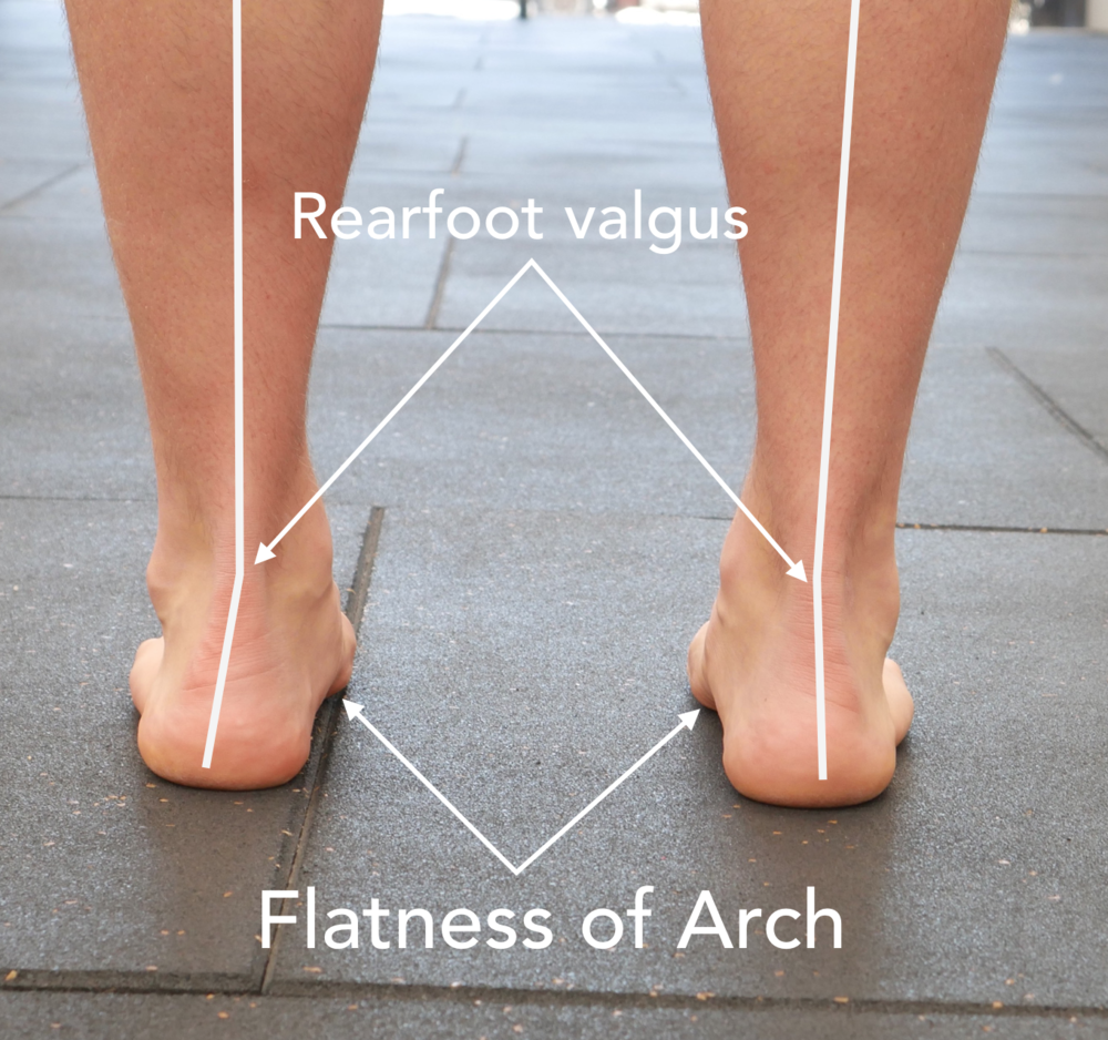 Rearfoot
