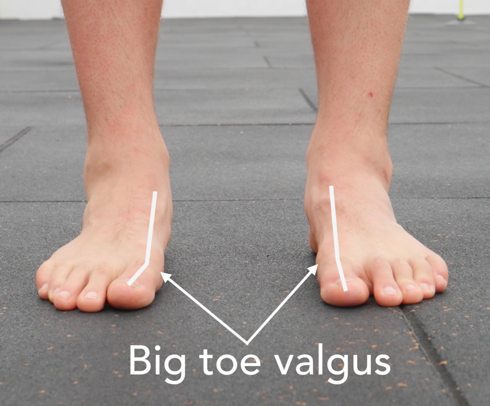 Forefoot