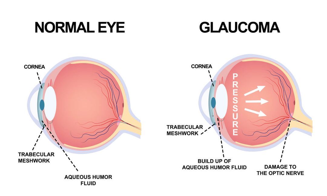 can-glaucoma-be-cured-by-laser-treatment