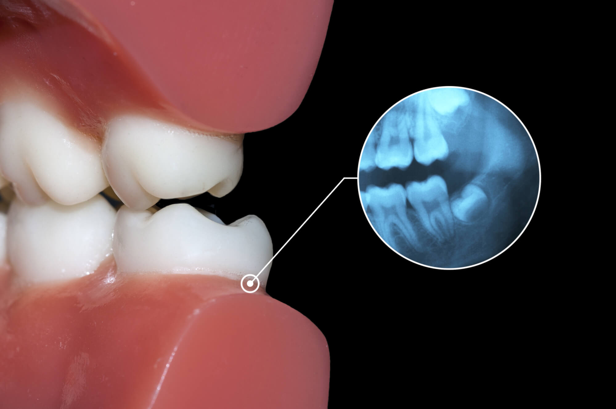impacted wisdom tooth needing Wisdom Teeth Removal 76210 impacted wisdom tooth needing Wisdom Teeth Removal 76210