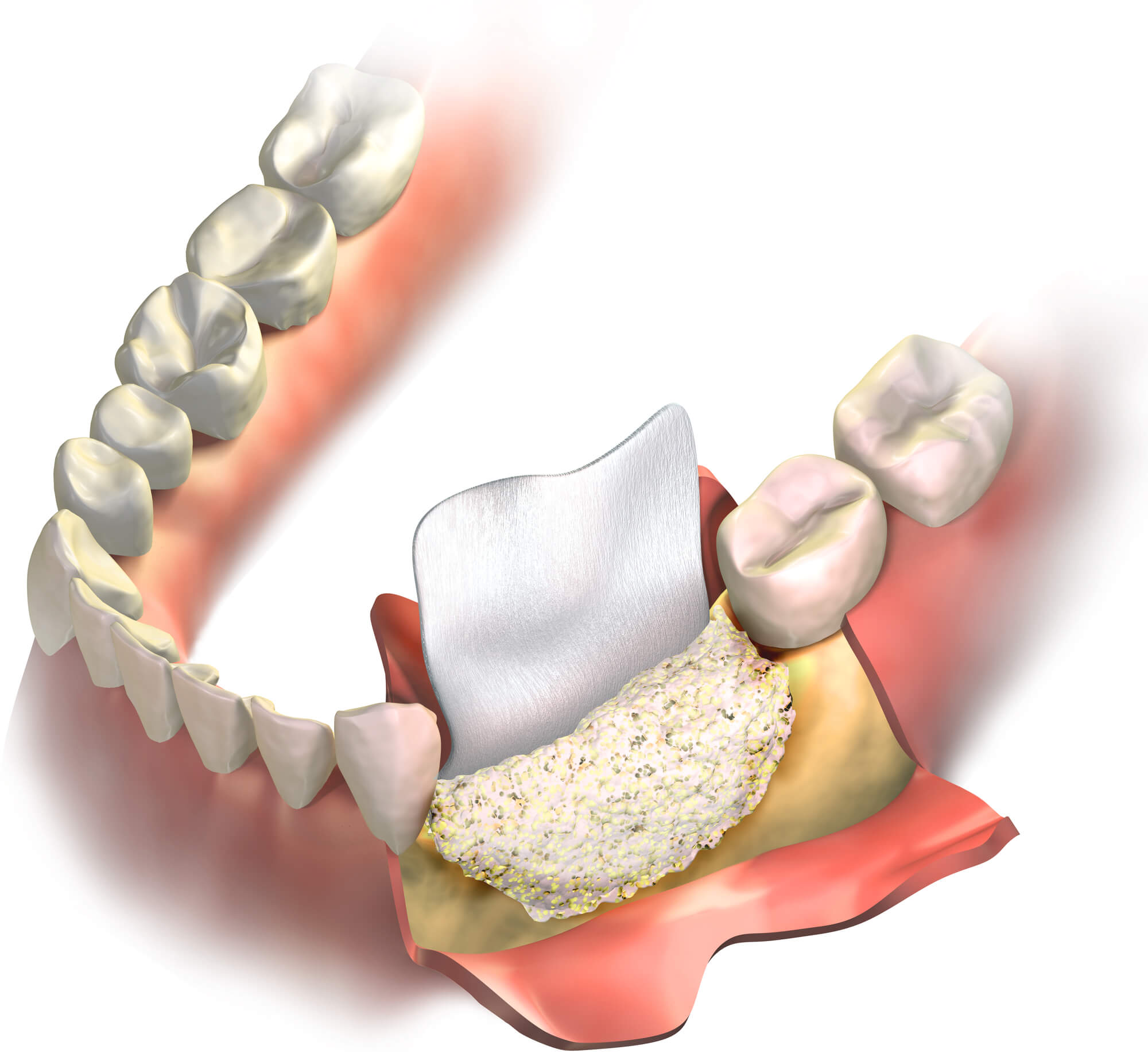 3D illustration of a Bone grafting procedure in 76210 3D illustration of a Bone grafting procedure in 76210