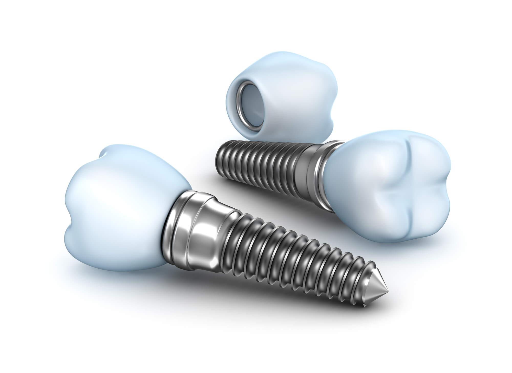 3D illustration of dental implants in 76210