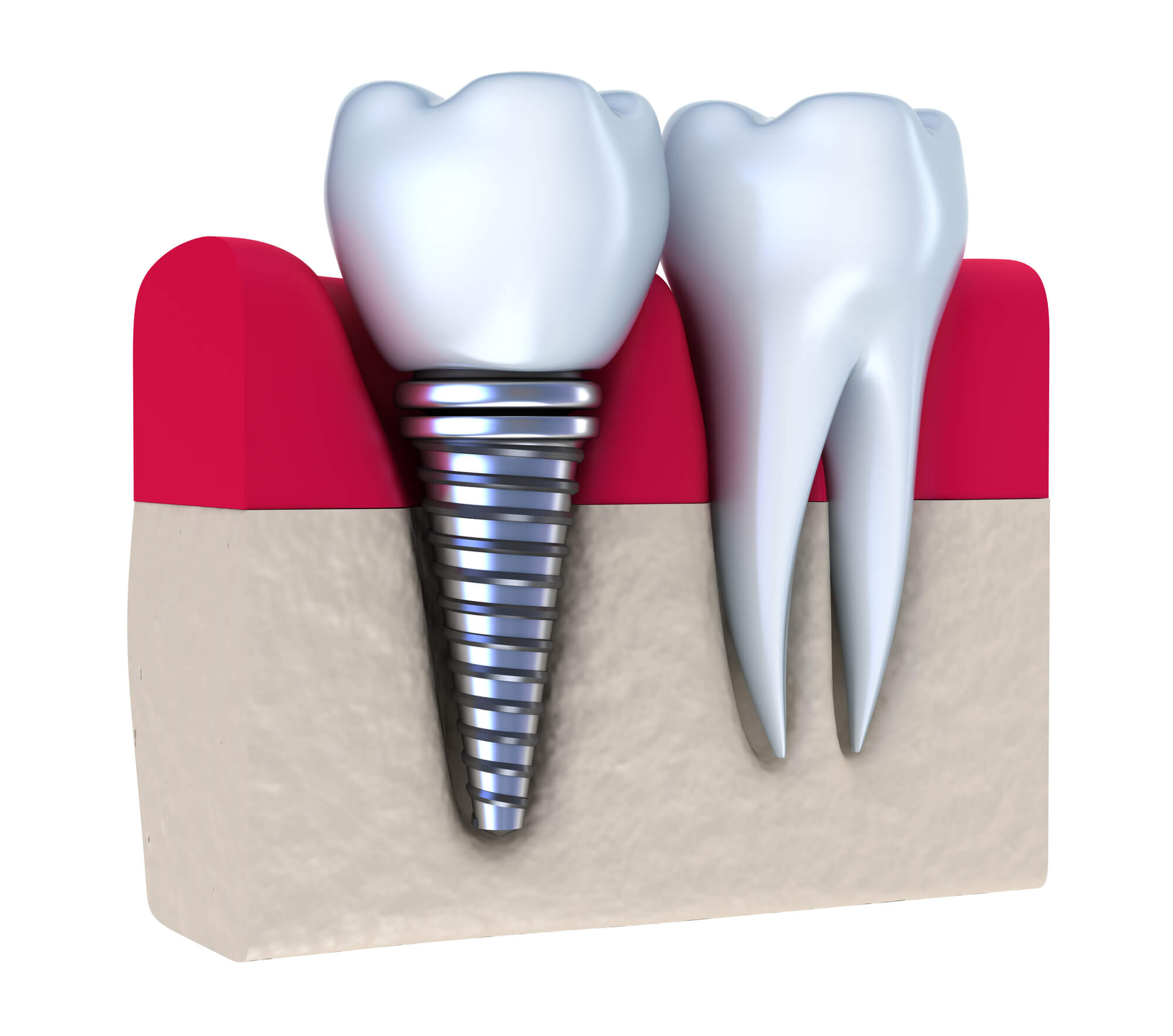 Surgical Dental Implants diagram Plano 
