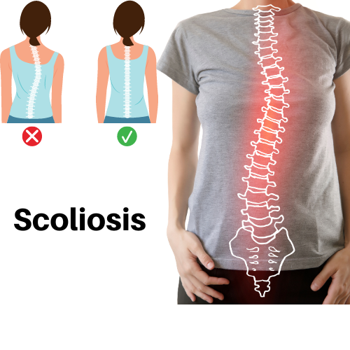 Superpowered treatment for Scoliosis Physical Therapy, Yoga, Pilates