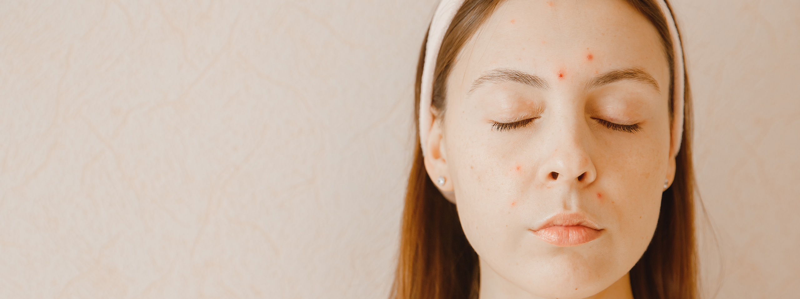 Is There a Link Between Hypothyroidism and Acne? Strut Blog