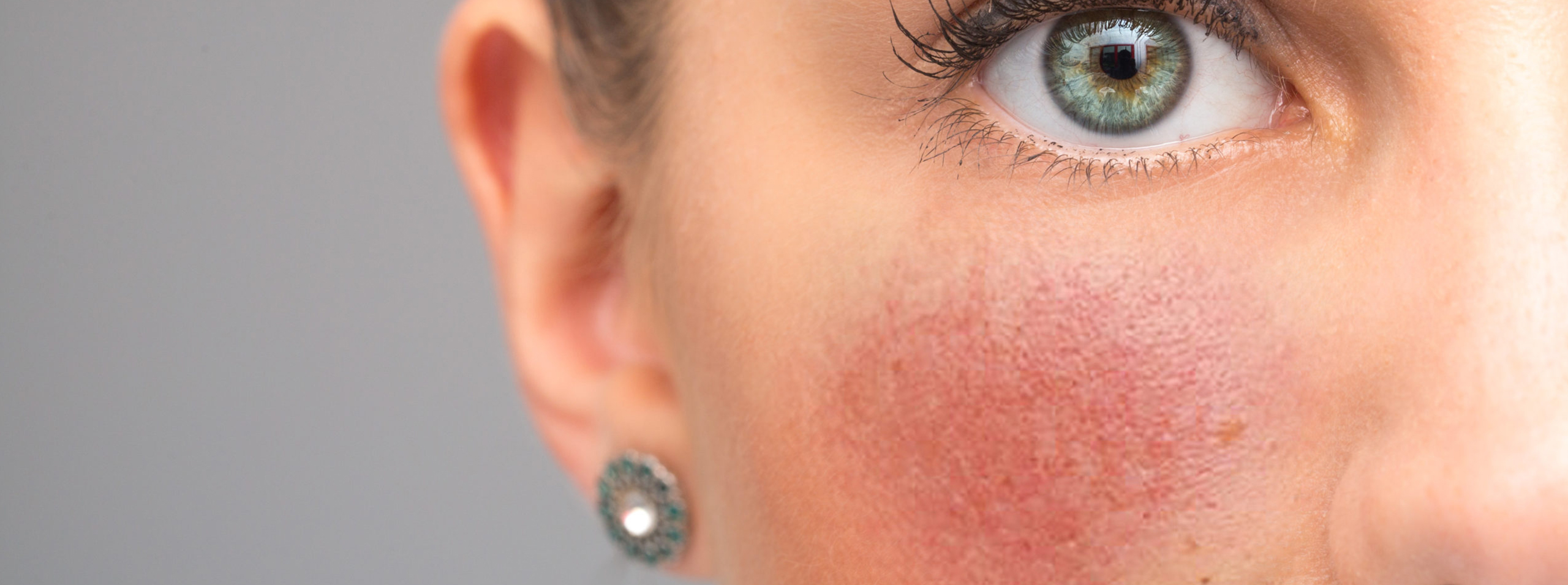 Medications for Rosacea Type 1 & 2 A Breakdown of Available Treatments