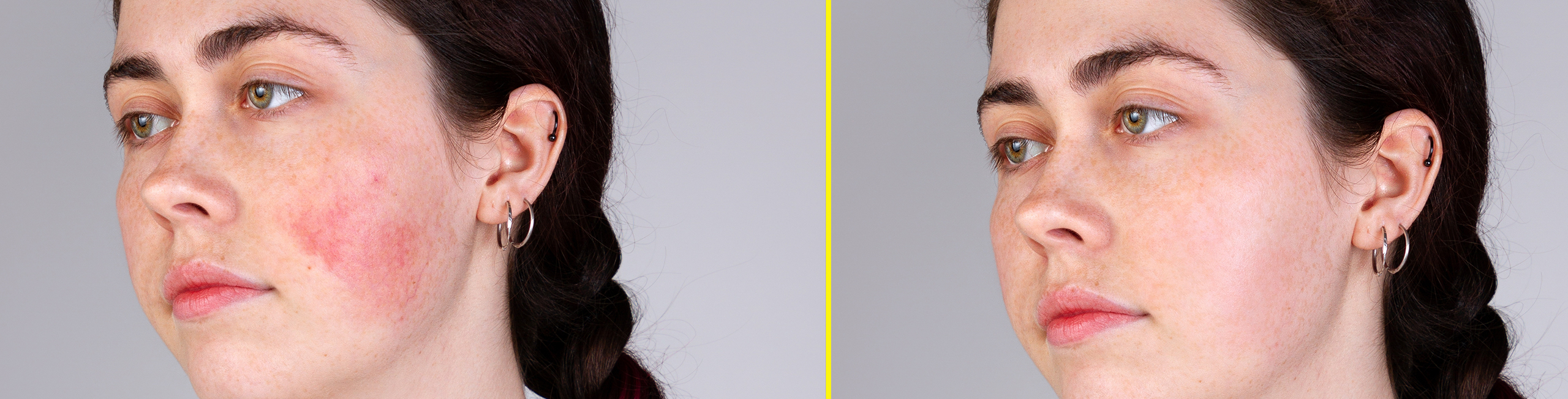 7 Easy Ways to Calm Your Rosacea Flareup Strut Blog