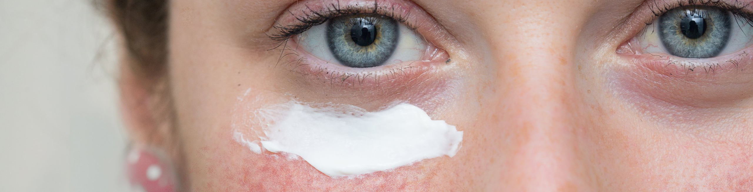 Ivermectin For Rosacea