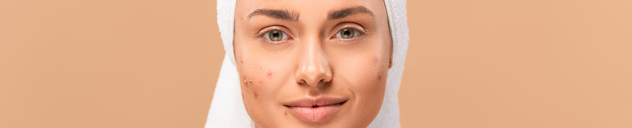 What Is Steroid Acne? Causes & 3 Effective Treatments - Strut Blog