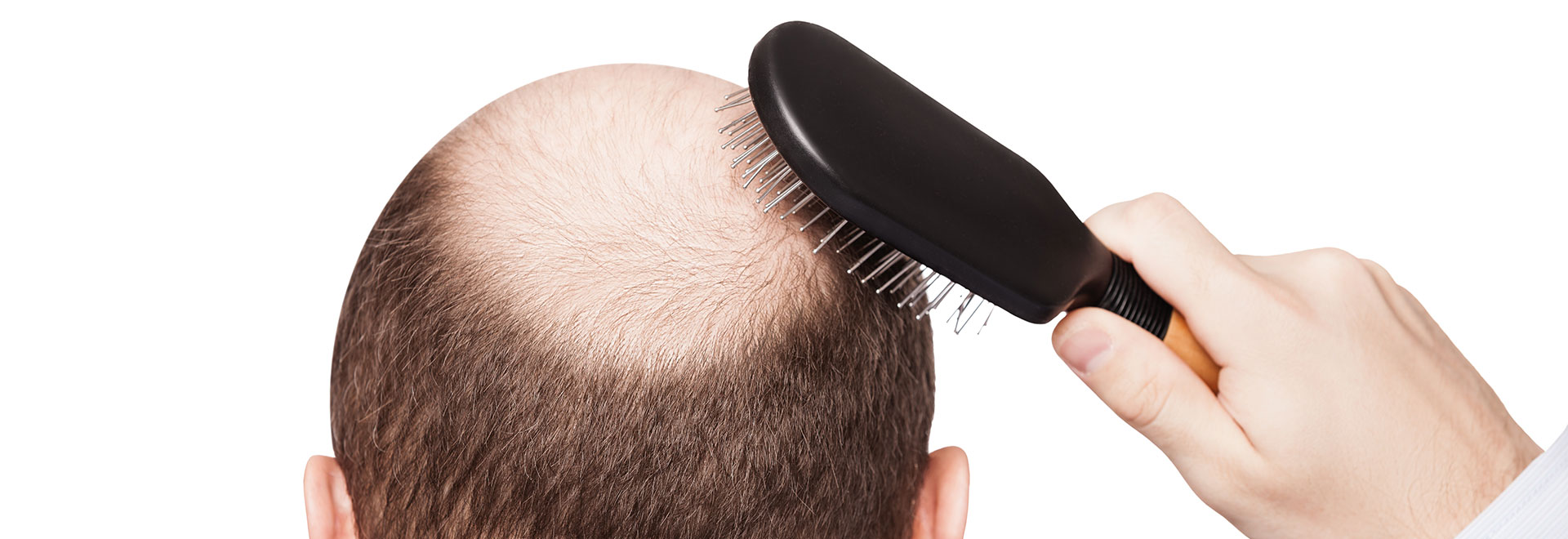 Is There a Cure for Baldness? Setting Realistic Hair Loss Treatment Expectations Strut Blog