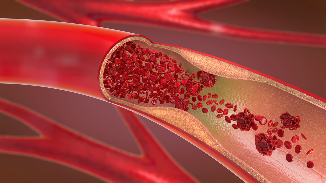 Do You Have Blood Clots In Your Legs? It May Be Caused By Vein Disease.