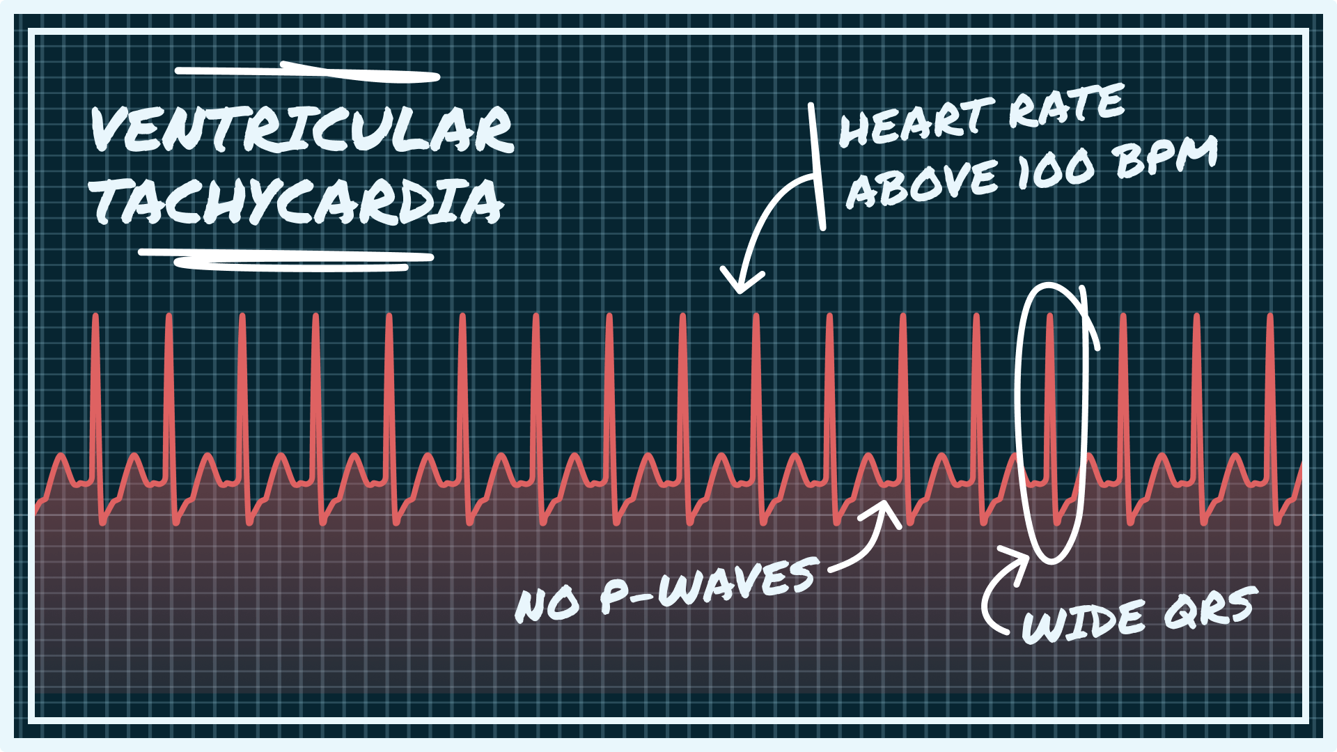 Ventricular Tachycardia Ecg