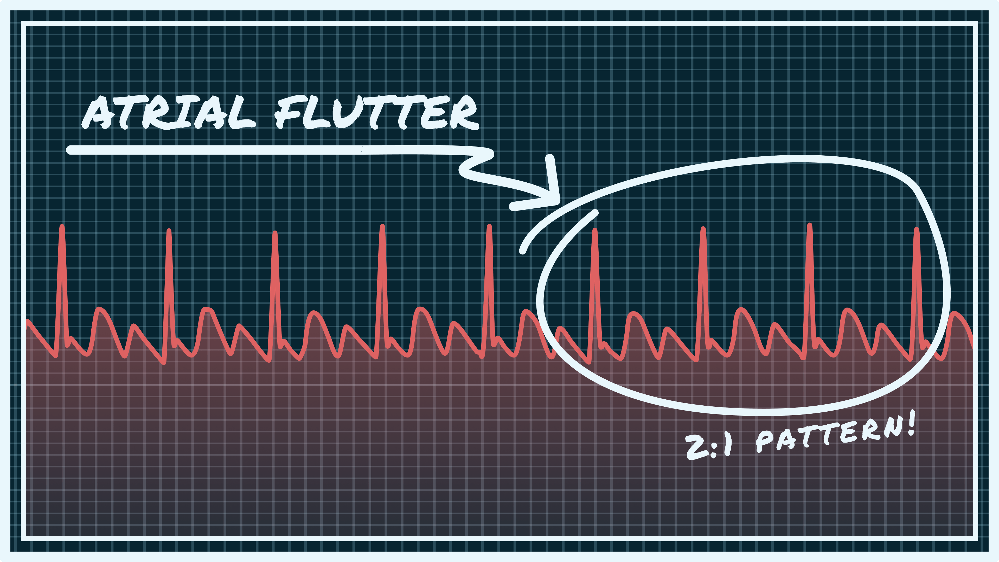 What Atrial Flutter Looks Like on Your Watch ECG | Qaly