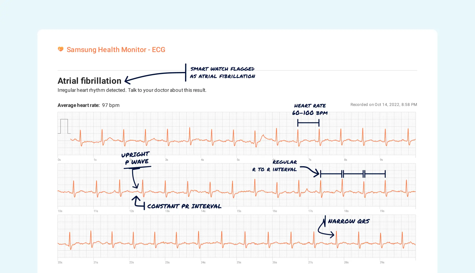 Sinus Rhythm Vs. Atrial Fibrillation on Your Watch ECG Qaly