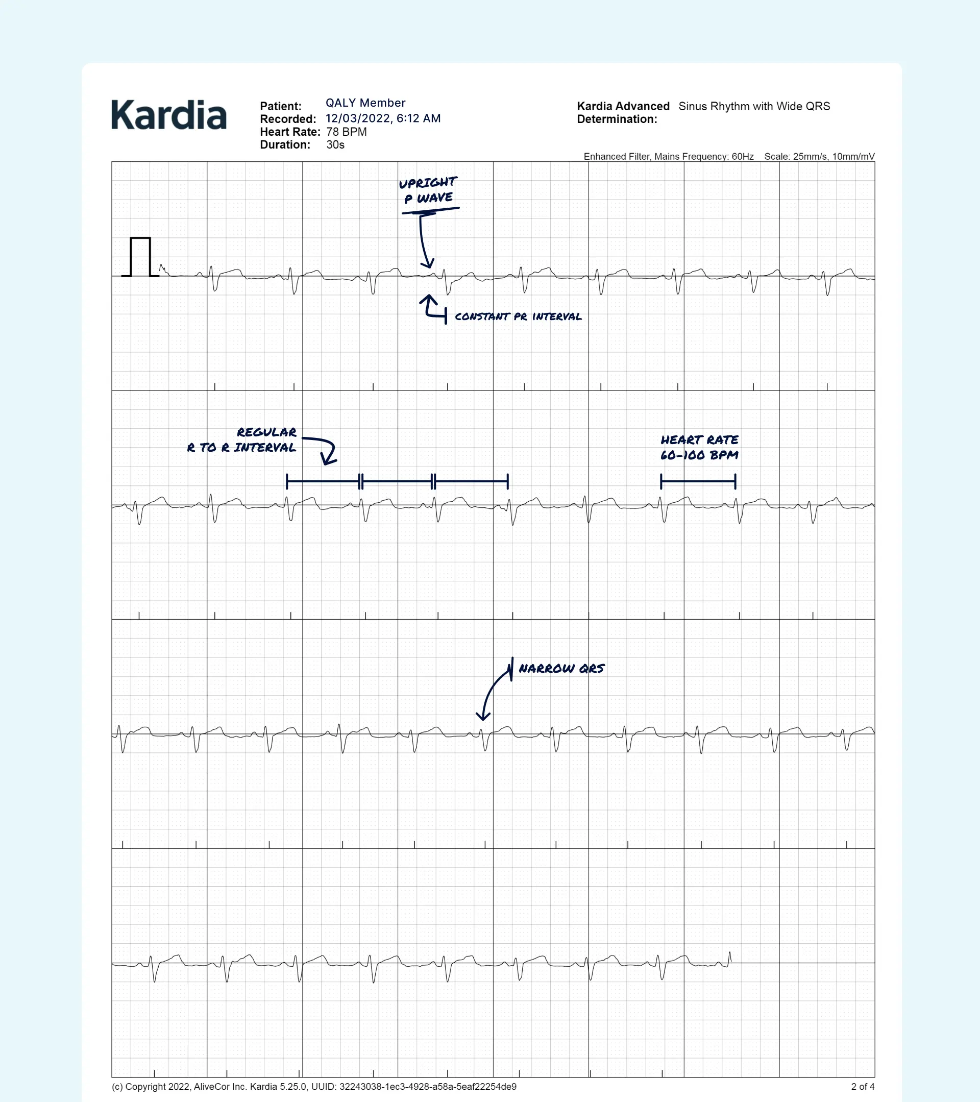 Sinus Rhythm Vs. Atrial Fibrillation on Your Watch ECG | Qaly