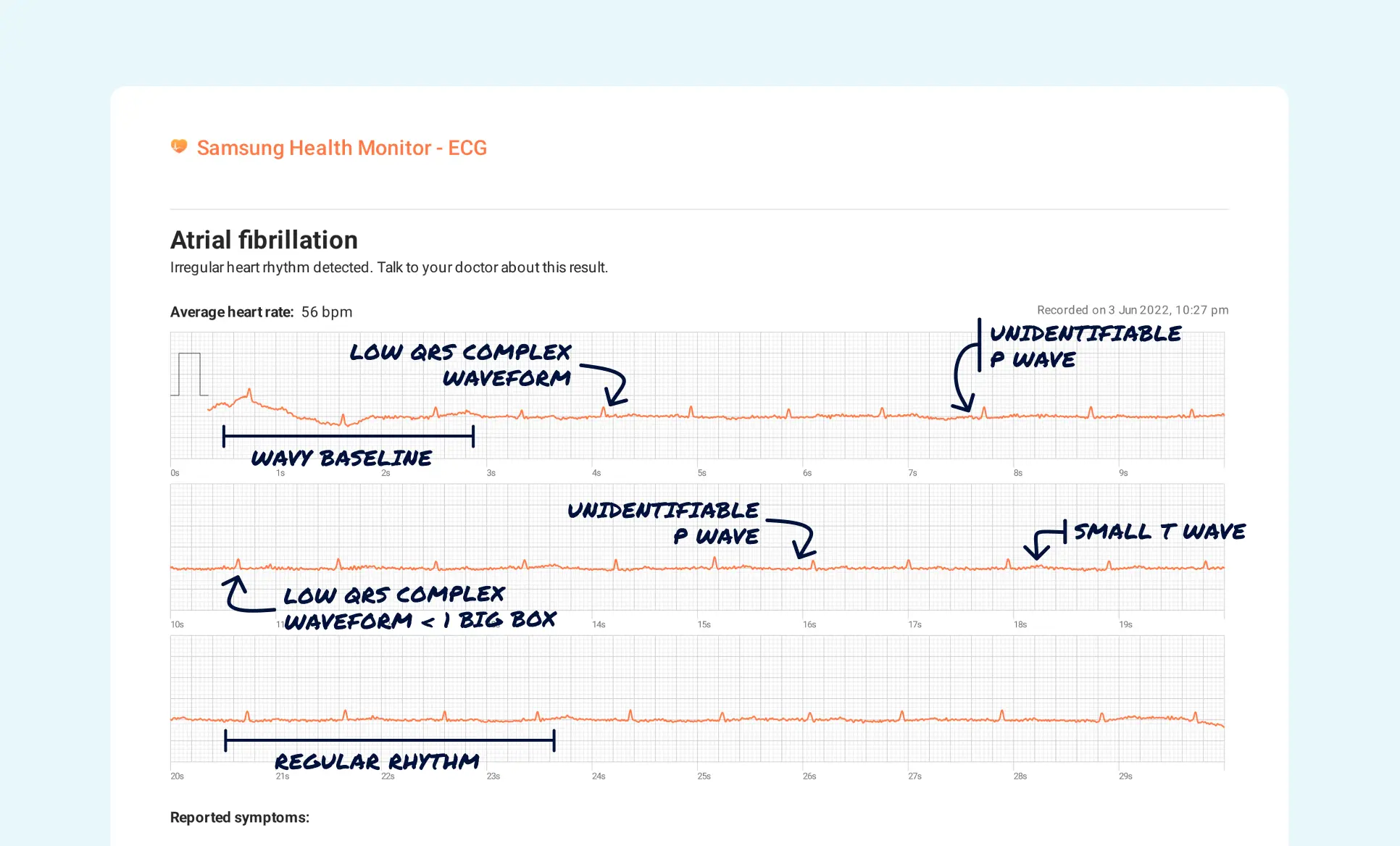Low Voltage Vs. Sinus Rhythm on Your Watch ECG | Qaly