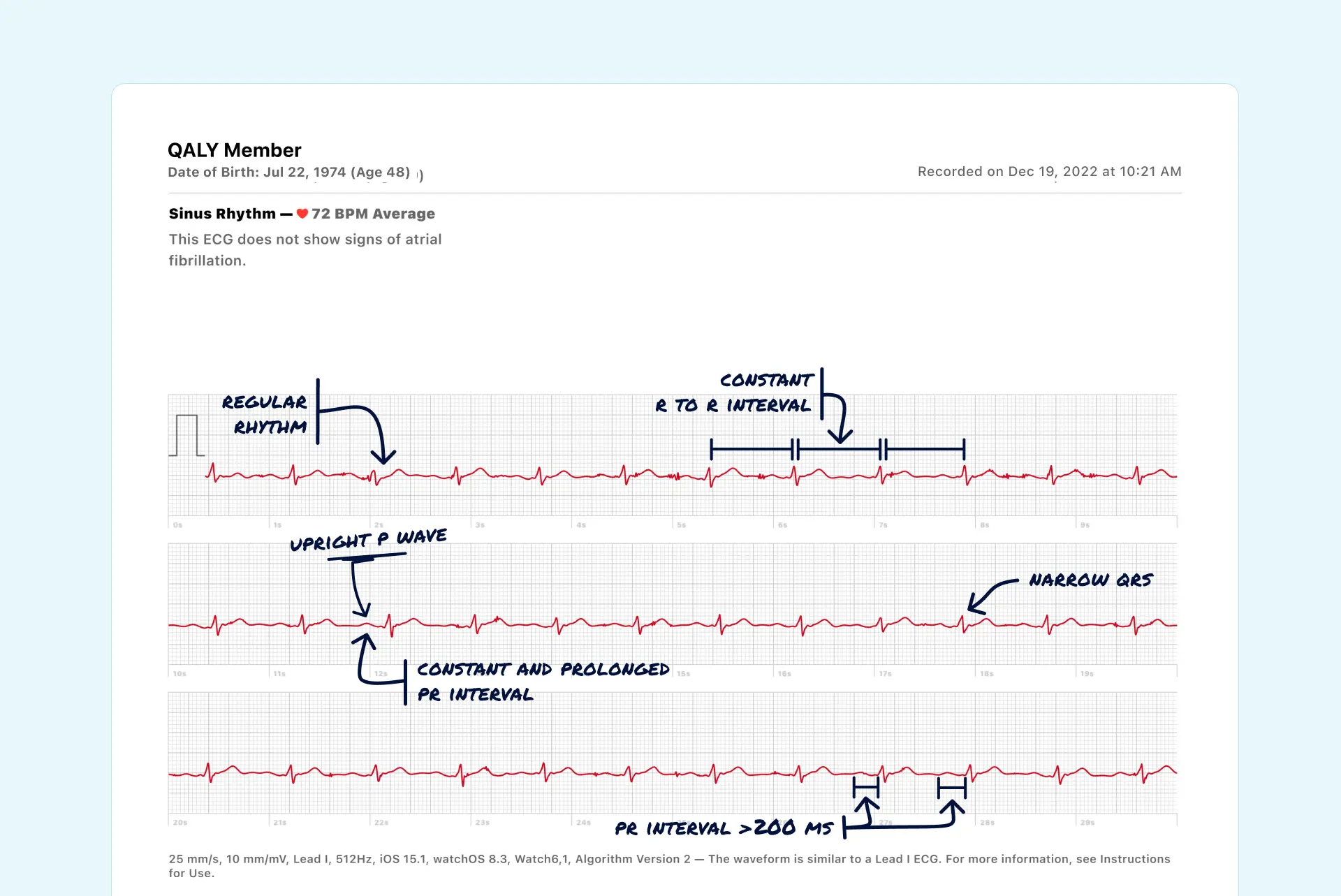 Junctional Rhythm Vs. First Degree AV Block on Your Watch ECG Qaly
