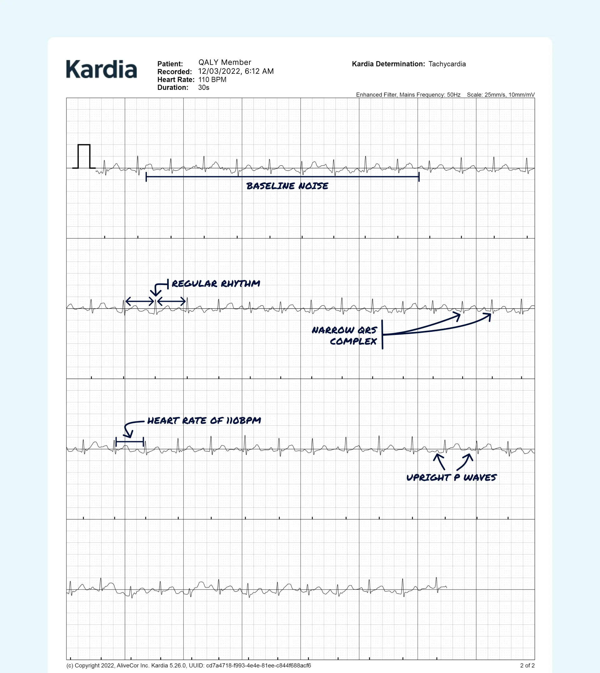 Sinus Tachycardia vs Ventricular Tachycardia on Your Watch ECG | Qaly