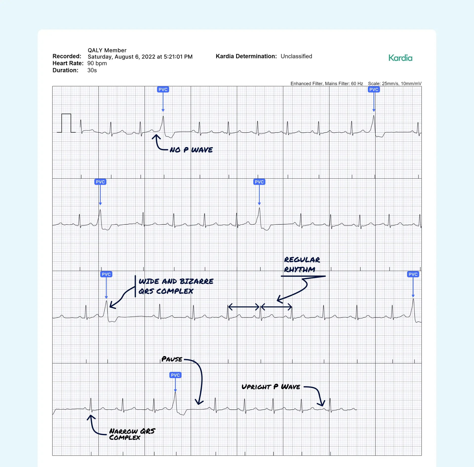 Premature Ventricular Contraction (Multiple) Vs. Premature Ventricular