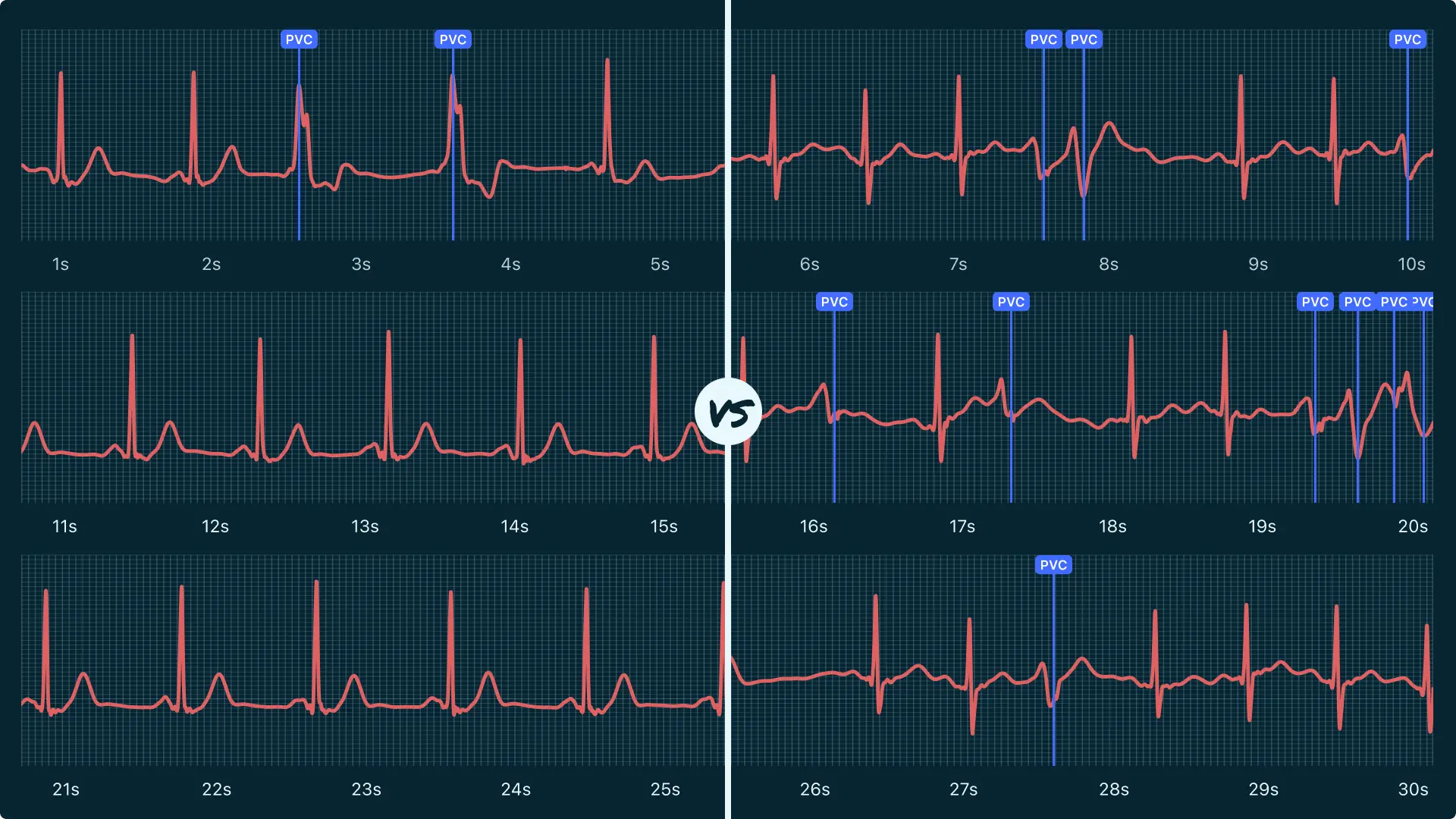 Premature Ventricular Contraction (Couplet) Vs. Ventricular Tachycardia ...