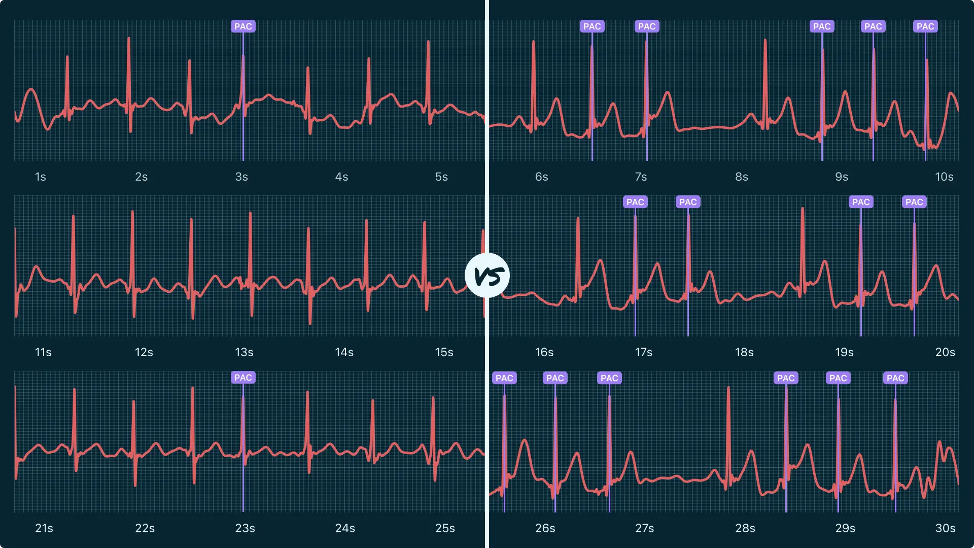 Premature Atrial Contraction (Multiple) Vs. Supraventricular ...